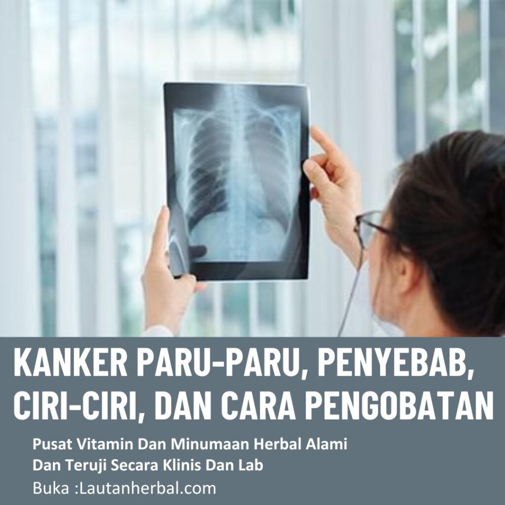 Kanker Paru-Paru, Penyebab, Ciri-Ciri, dan Cara Mengobatinya